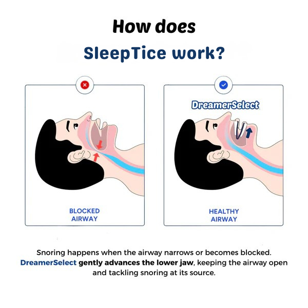 SleepTice™ Anti Snoring Mouthpiece